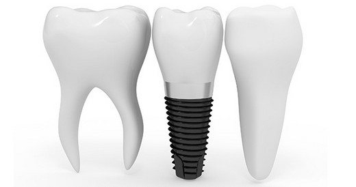 İmplant hakkında merak ettiğiniz her şey